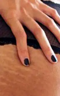 Cum să scapi de vergeturi. 3 remedii naturiste eficiente pentru a le estompa